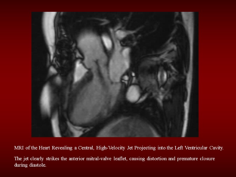 MRI of the Heart Revealing a Central, High-Velocity Jet Projecting into the Left Ventricular